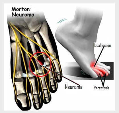 El neuroma de Morton
