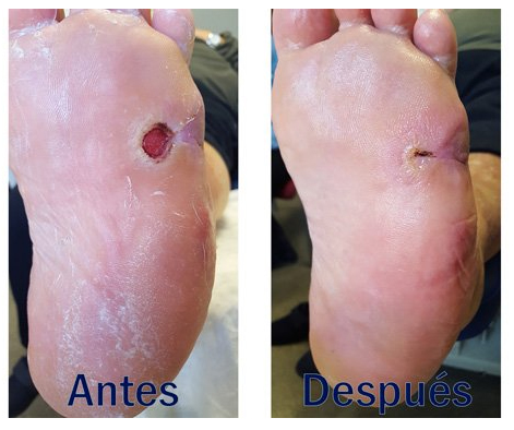 Patologías del Pie: EL PIE DIABÉTICO