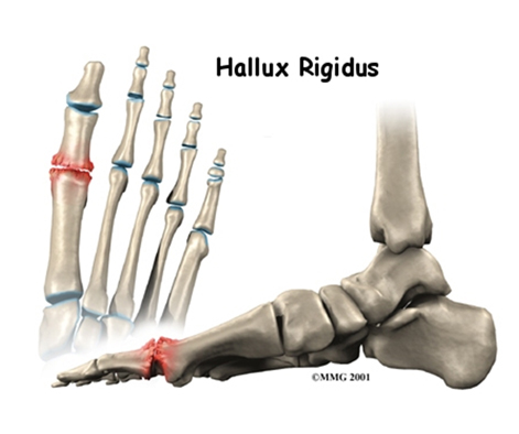 Hallus Rígidus