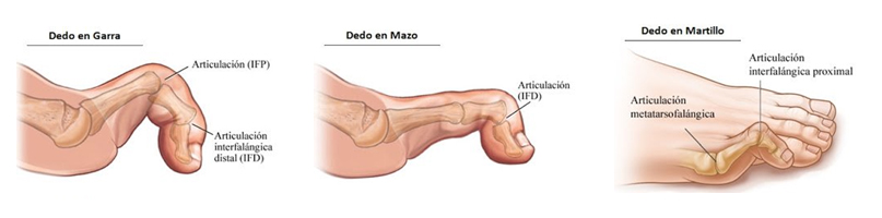 DEDOS EN GARRA O MARTILLOn